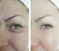 Woman eyes wrinkles puffiness result before and after beautician treatment Royalty Free Stock Photo