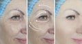 Woman eyes wrinkles removal result correction rejuvenation bag before and after treatment Royalty Free Stock Photo