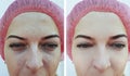 Woman eyes wrinkles before and after  result treatment Royalty Free Stock Photo