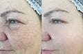 Woman eyes wrinkles before and after rosacea correction treatment plastic blepharoplasty Royalty Free Stock Photo