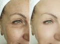 Woman eyes wrinkles before and after  beautician treatment Royalty Free Stock Photo