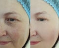 Woman eyes wrinkles regeneration   before and after treatment correction Royalty Free Stock Photo