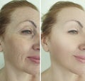 Woman eyes wrinkles before and after treatment regeneration Royalty Free Stock Photo