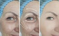 Woman eyes wrinkles removal result therapy correction rejuvenation bag before and after treatment Royalty Free Stock Photo