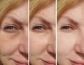 Woman eyes wrinkles antiaging  crease correction contrast revitalization collage treatment before and after treatment effect Royalty Free Stock Photo