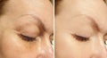 Woman eyes wrinkles correction contrast revitalization collage treatment before and after treatment effect