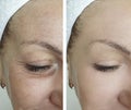 Woman eyes wrinkles before and after treatment Royalty Free Stock Photo