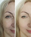 Woman eyes wrinkles before and after treatment Royalty Free Stock Photo