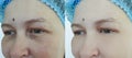 Woman eyes wrinkles before and after treatment Royalty Free Stock Photo