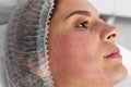 Woman after face biorevitalization procedure in salon, closeup. Royalty Free Stock Photo