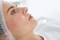 Woman after face biorevitalization procedure in salon, closeup. Royalty Free Stock Photo