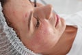 Woman after face biorevitalization procedure in salon, closeup. Royalty Free Stock Photo