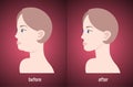 Woman face before and after double chin fat correction procedure aesthetic medicine concept horizontal portrait Royalty Free Stock Photo