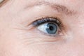 Woman face, eye wrinkles before treatment - the result of rejuvenating cosmetological procedures of biorevitalization, face Royalty Free Stock Photo