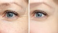 Woman face, eye wrinkles before and after treatment - the result of rejuvenating cosmetological procedures of biorevitalization, Royalty Free Stock Photo