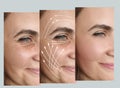 Woman face lift before and after plastic rejuvenation cosmetology treatment