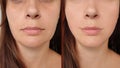 Woman face lift before and after treatment effect