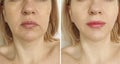 Woman face lift before and after treatment plastic