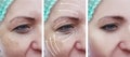 woman face wrinkles patient therapy beautician rejuvenation before and after correction cosmetology procedures Royalty Free Stock Photo