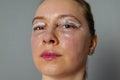 woman face after plastic surgery, blepharoplasty operation, swelling eye bags, incisions with removable stitches Royalty Free Stock Photo