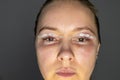 woman face after plastic surgery, blepharoplasty operation, swelling eye bags, incisions with removable stitches Royalty Free Stock Photo