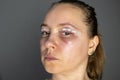 woman face after plastic surgery, blepharoplasty operation, swelling eye bags, incisions with removable stitches Royalty Free Stock Photo