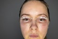 woman face after plastic surgery, blepharoplasty operation, swelling eye bags, incisions with removable stitches Royalty Free Stock Photo