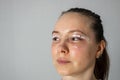 woman face after plastic surgery, blepharoplasty operation, swelling eye bags, incisions with removable stitches Royalty Free Stock Photo