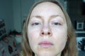 woman face after plastic surgery on eyes, blepharoplasty operation, incisions stitches, healing