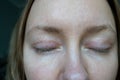 woman face after plastic surgery on eyes, blepharoplasty operation, incisions stitches, healing