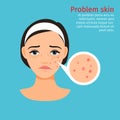 Woman face problem skin with acne