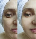 Woman removal collagen saggy beautician wrinkles tension regeneration rejuvenation before and after treatment, arrow