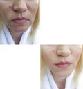 Woman circles skin face correction therapy wrinkles collage effect tension lifting before after antiaging