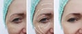 Woman face wrinkles patient skin rejuvenation before and after correction cosmetology procedures Royalty Free Stock Photo