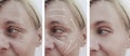 Woman skin face wrinkles effect aging results correction before and after procedures, arrow Royalty Free Stock Photo