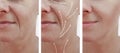 Woman skin face wrinkles effect aging treatment results correction before and after procedures, arrow Royalty Free Stock Photo