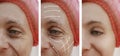 Woman skin face wrinkles effect results correction before and after procedures, arrow Royalty Free Stock Photo