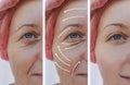 Woman skin face wrinkles correction before and after procedures, arrow Royalty Free Stock Photo