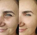 Woman skin  face wrinkles facelift correction  rejuvenation  result  therapy before and after treatment collage, puffing Royalty Free Stock Photo