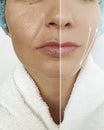 Woman face before and after tightening,result collage correction wrinkles