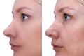 Woman face, before and after treatment - the result of rejuvenating cosmetological procedures of biorevitalization, face lifting