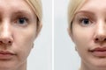 Woman face with wrinkles and age change before and after treatment - the result of rejuvenating cosmetological procedures of Royalty Free Stock Photo