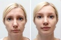 Woman face with wrinkles and age change before and after treatment - the result of rejuvenating cosmetological procedures of Royalty Free Stock Photo