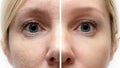 Woman face with wrinkles and age change before and after treatment - the result of rejuvenating cosmetological procedures of Royalty Free Stock Photo