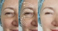 Woman face wrinkles  aging  before and after regeneration removal hydrating treatment Royalty Free Stock Photo