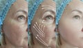 Woman face wrinkles aging revitalization therapy before and after regeneration removal hydrating treatment Royalty Free Stock Photo