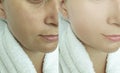 Woman face wrinkles antiaging saggy medicine lifting before and after treatment