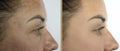 Woman face wrinkles beautician crease blepharoplasty before and after treatment pigmentation