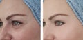 Woman face wrinkles before and after beautician therapy results collage  effect Royalty Free Stock Photo