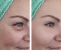 Woman face wrinkles before and after beautician therapy results collage treatments effect Royalty Free Stock Photo